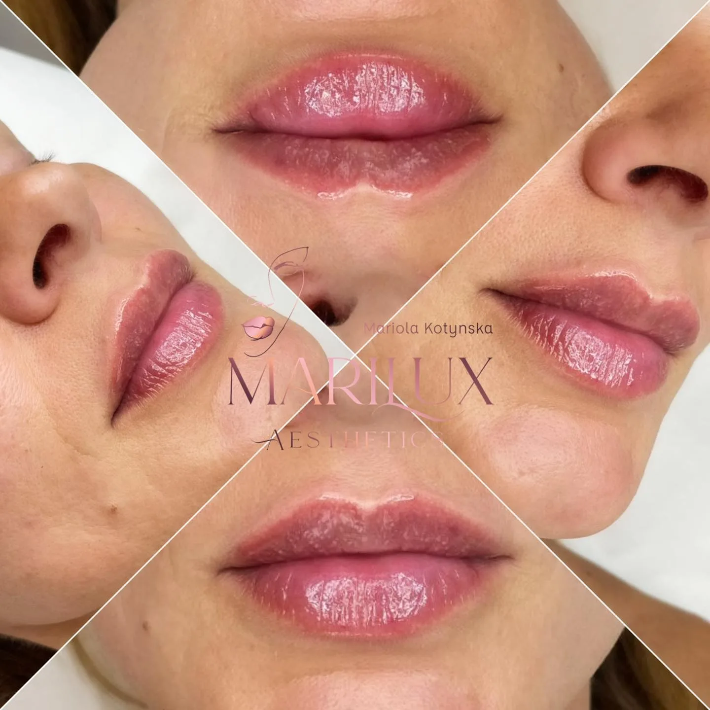 Lip filler results collage — multiple clients